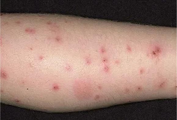 Flea pest control Melbourne outdoor yard treatment